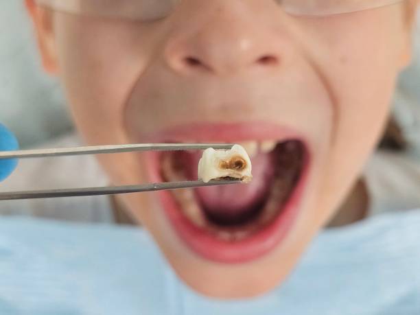 Best Broken or Cracked Tooth Emergency Dentist in Summerside, OH